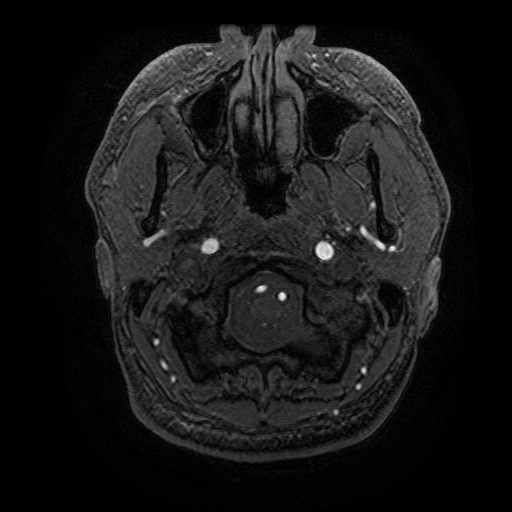 Arteriovenous malformation (Radiopaedia 71628-81999 Axial MRA 32).jpg