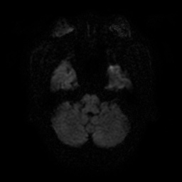 File:Artery of Percheron infarction (Radiopaedia 27975-28230 Axial DWI 7).jpg