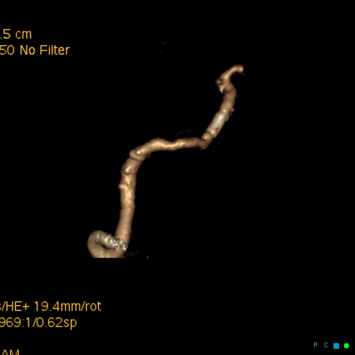 File:Artifactual basilar artery stenosis due to metallic stent (Radiopaedia 31206-31923 C 7).jpg