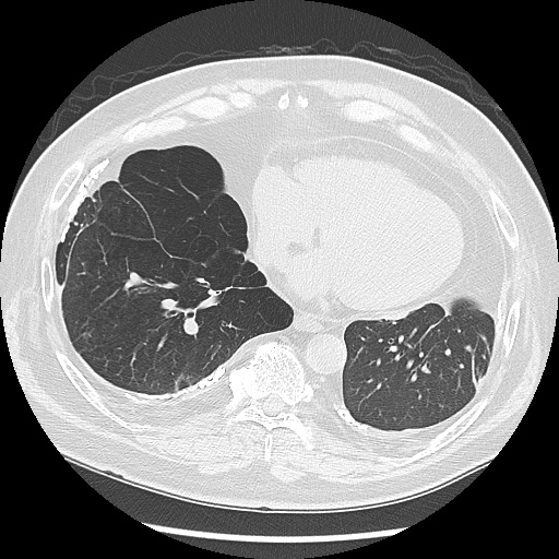 Asbestos-related pleural disease (Radiopaedia 74366-85250 Axial lung window 81).jpg
