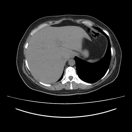 Ascending retrocecal appendicitis with liver abscesses (Radiopaedia 60066-67615 Axial non-contrast 15).jpg