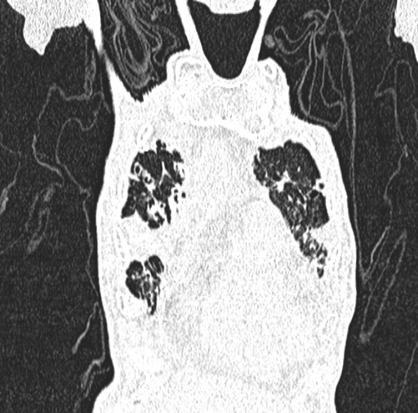 Aspergilloma- with Monod sign (Radiopaedia 44737-48532 Coronal lung window 139).jpg