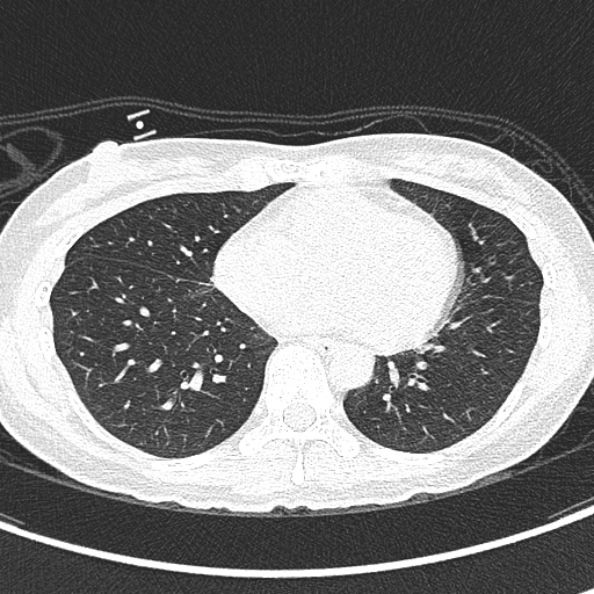 Aspergilloma (Radiopaedia 26223-26347 Axial lung window 50).jpg
