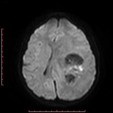 Astroblastoma (Radiopaedia 74287-85162 Axial DWI 65).jpg