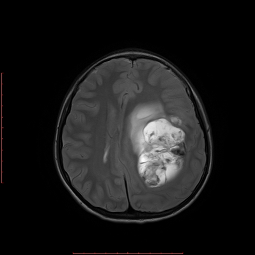 File:Astroblastoma (Radiopaedia 74287-85162 Axial T2 14).jpg
