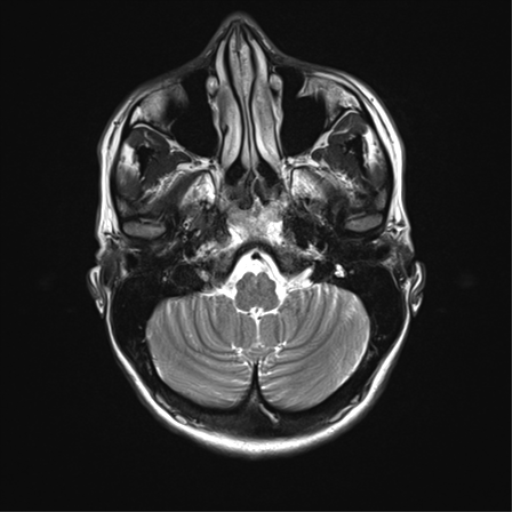 File:Astrocytoma, IDH-mutant - grade 3 (Radiopaedia 50046-55341 Axial 31).png