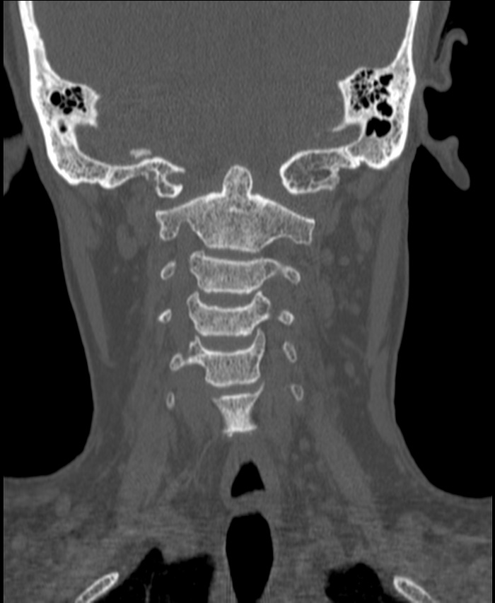 Atlanto-occipital assimilation with basilar invagination (Radiopaedia 70122-80188 Coronal bone window 95).jpg