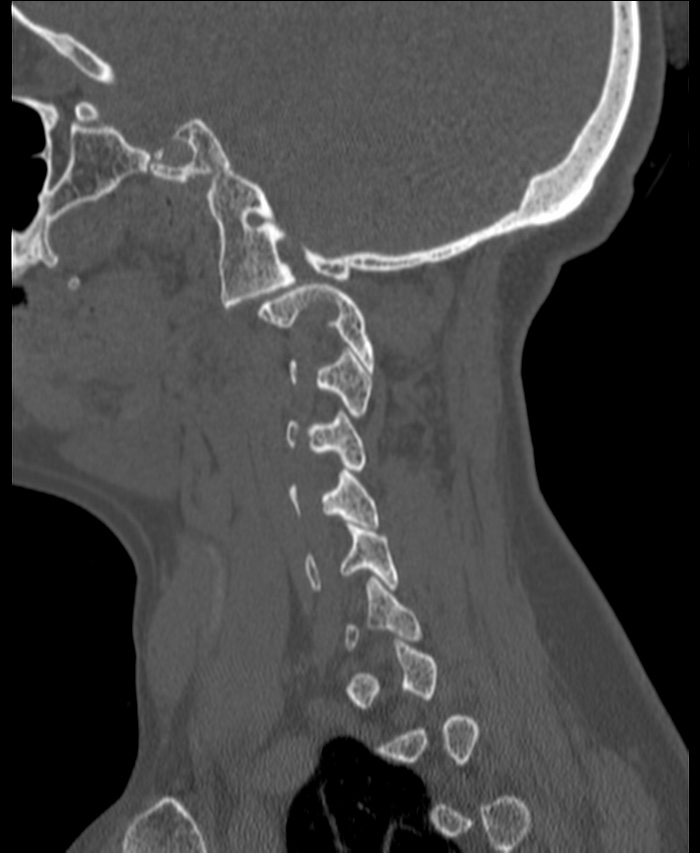 Atlanto-occipital assimilation with basilar invagination (Radiopaedia 70122-80188 Sagittal bone window 9).jpg