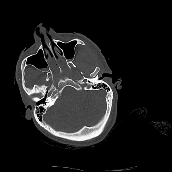 File:Atlanto-occipital dissociation (Traynelis type 1), C2 teardrop fracture, C6-7 facet joint dislocation (Radiopaedia 87655-104061 Axial bone window 3).jpg