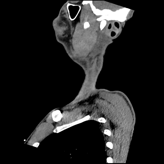 Atlanto-occipital dissociation (Traynelis type 1), C2 teardrop fracture, C6-7 facet joint dislocation (Radiopaedia 87655-104061 D 14).jpg