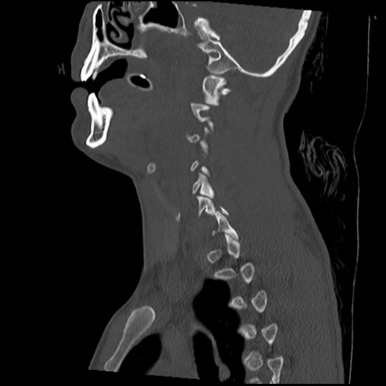 Atlanto-occipital dissociation (Traynelis type 1), C2 teardrop fracture, C6-7 facet joint dislocation (Radiopaedia 87655-104061 Sagittal bone window 25).jpg