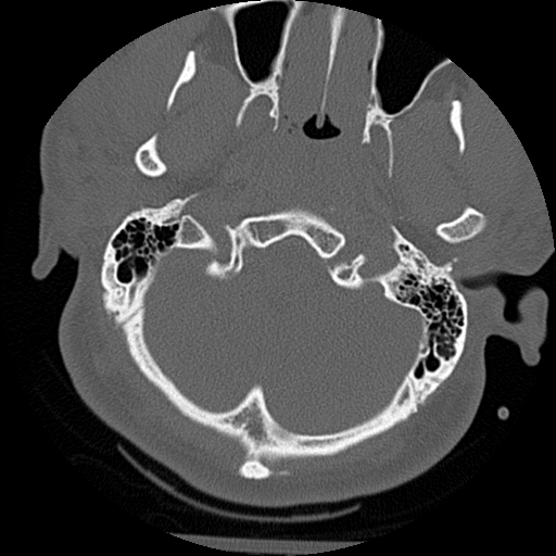 Atlanto-occipital dissociation injury (Radiopaedia 29274-29698 Axial bone window 4).png