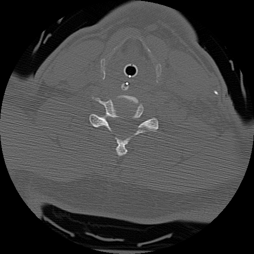 Atlanto-occipital dissociation injury (Radiopaedia 29274-29698 Axial bone window 52).png