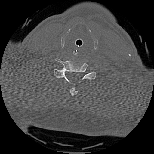 Atlanto-occipital dissociation injury (Radiopaedia 29274-29698 Axial bone window 53).png