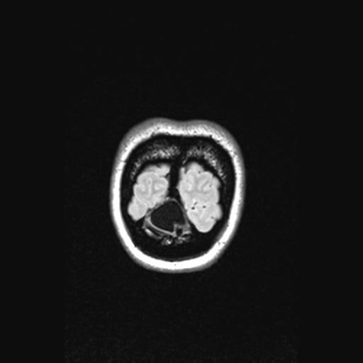 Atretic encephalocoele with inferior vermis hypoplasia (Radiopaedia 30443-31108 Coronal FLAIR 18).jpg