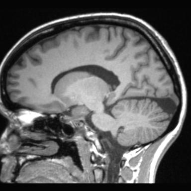 Atretic encephalocoele with inferior vermis hypoplasia (Radiopaedia 30443-31108 Sagittal T1 78).jpg