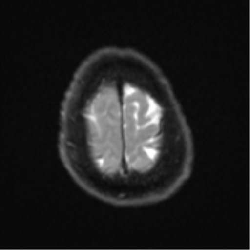 Atypical meningioma (WHO Grade II) (Radiopaedia 54742-60981 Axial DWI 25).png