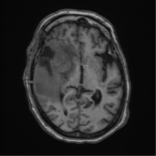 Atypical meningioma (WHO Grade II) (Radiopaedia 54742-60981 Axial T1 33).png