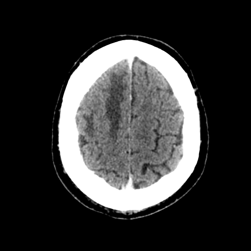 Atypical meningioma (WHO grade II) with brain invasion (Radiopaedia 57767-64728 Axial C+ 11).png