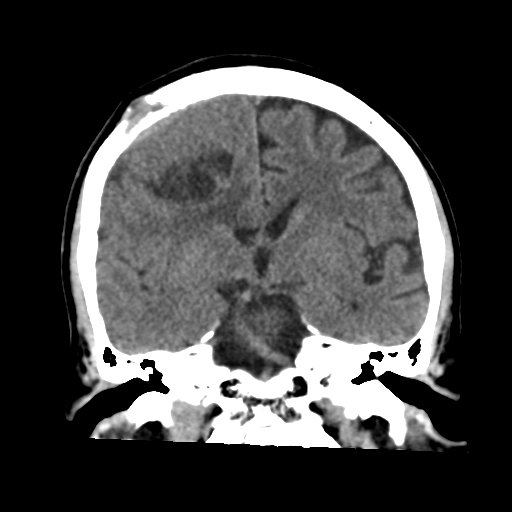 Atypical meningioma (WHO grade II) with osseous invasion (Radiopaedia 53654-59715 Coronal non-contrast 33).png