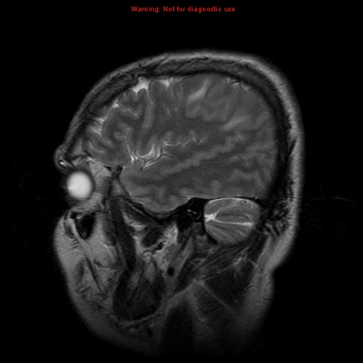File:Atypical meningioma - grade II (Radiopaedia 13303-13305 Sagittal T2 5).jpg