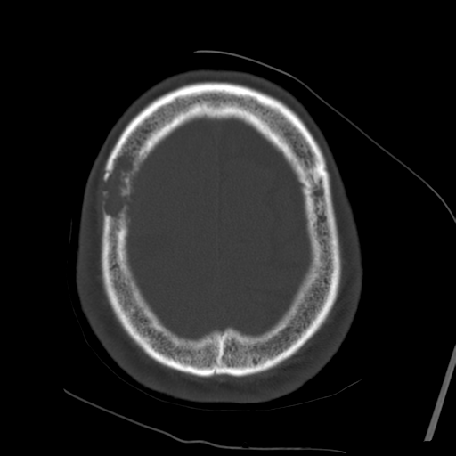 Atypical meningioma with skull invasion (Radiopaedia 34357-35649 Axial bone window 69).png