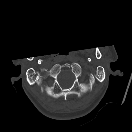 Atypical meningioma with skull invasion (Radiopaedia 34357-35649 Axial bone window 9).png