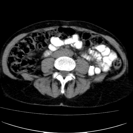 File:Atypical renal cyst (Radiopaedia 17536-17251 non-contrast 29).jpg