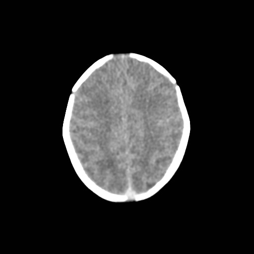 File:Atypical teratoid rhabdoid tumor (prenatal US and neonatal MRI) (Radiopaedia 59091-66387 Axial non-contrast 31).jpg