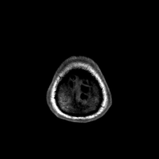 Autoimmune limbic encephalitis (Radiopaedia 30363-31005 T1 Axial 1mm 146).jpg