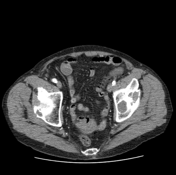 Autosomal dominant polycystic kidney disease (Radiopaedia 27851-28094 B 110).jpg