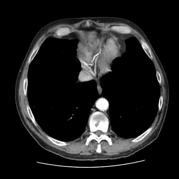 Autosomal dominant polycystic kidney disease (Radiopaedia 27851-28094 B 46).jpg