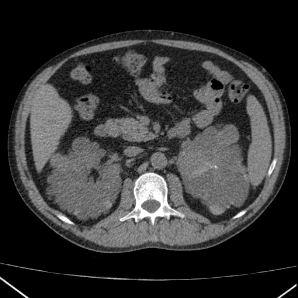 File:Autosomal dominant polycystic kidney disease (Radiopaedia 36539-38101 Axial non-contrast 33).jpg