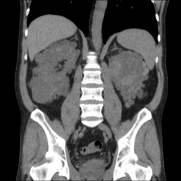 Autosomal dominant polycystic kidney disease (Radiopaedia 36539-38101 C 44).jpg
