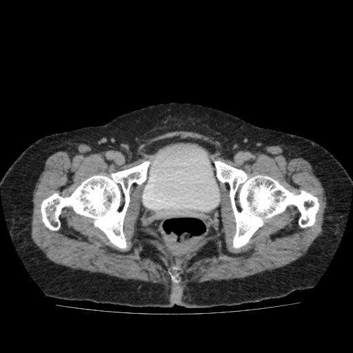 Autosomal dominant polycystic kidney disease (Radiopaedia 38189-40194 Axial C+ delayed 58).jpg