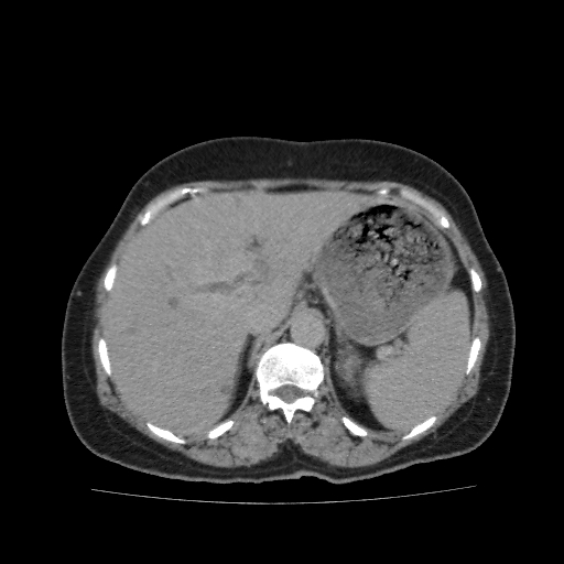File:Autosomal dominant polycystic kidney disease (Radiopaedia 38189-40194 Axial C+ delayed 9).jpg