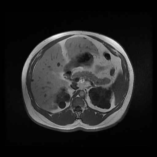Autosomal dominant polycystic kidney disease (Radiopaedia 50259-55611 Axial 2D Dual Echo 36).jpg