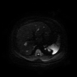 Autosomal dominant polycystic kidney disease (Radiopaedia 50259-55611 Axial DWI 49).jpg