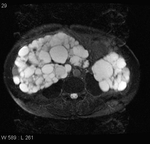 File:Autosomal dominant polycystic kidney disease (Radiopaedia 5202-6969 Axial T2 fat sat 12).jpg