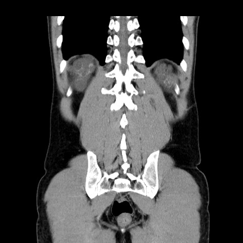 Autosomal dominant polycystic kidney disease (Radiopaedia 66349-75582 A 78).jpg