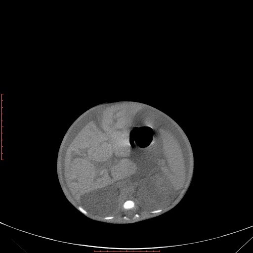Autosomal recessive polycystic kidney disease associated with Caroli disease (Radiopaedia 61932-69984 Axial non-contrast 165).jpg