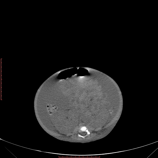 Autosomal recessive polycystic kidney disease associated with Caroli disease (Radiopaedia 61932-69984 Axial non-contrast 250).jpg