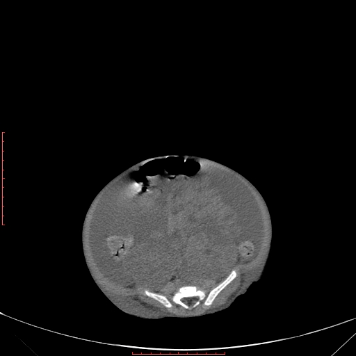 Autosomal recessive polycystic kidney disease associated with Caroli disease (Radiopaedia 61932-69984 Axial non-contrast 274).jpg