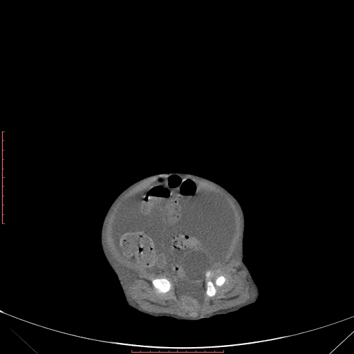Autosomal recessive polycystic kidney disease associated with Caroli disease (Radiopaedia 61932-69984 B 324).jpg