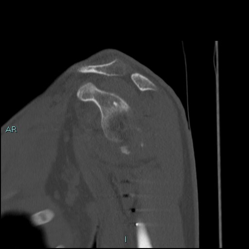 Avascular necrosis after fracture dislocations of the proximal humerus (Radiopaedia 88078-104653 Sagittal bone window 34).jpg