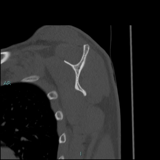Avascular necrosis after fracture dislocations of the proximal humerus (Radiopaedia 88078-104653 Sagittal bone window 49).jpg