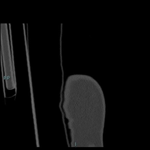 Avascular necrosis after fracture dislocations of the proximal humerus (Radiopaedia 88078-104655 Coronal bone window 10).jpg