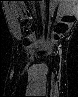Avascular necrosis of the capitate (Radiopaedia 88317-104948 Coronal T1 vibe 60).jpg