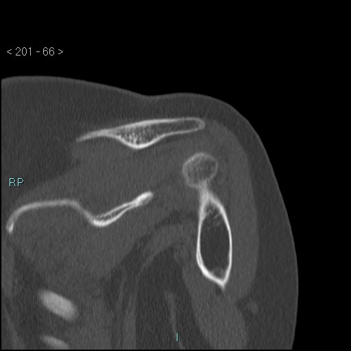 Avascular necrosis of the shoulder - Cruess stage I (Radiopaedia 77674-89887 Coronal bone window 65).jpg