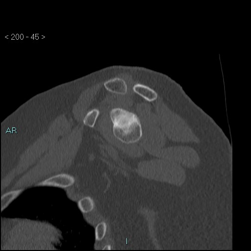Avascular necrosis of the shoulder - Cruess stage I (Radiopaedia 77674-89887 Sagittal bone window 44).jpg